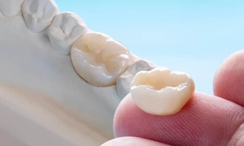 Porcelain Crowns