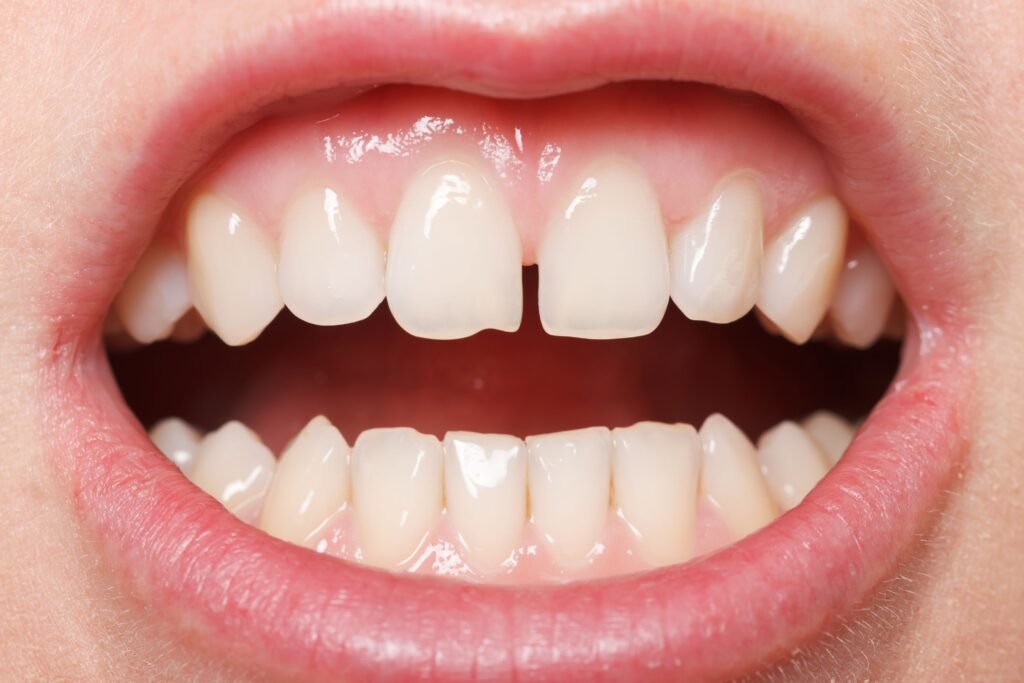 Gingivitis Prevention