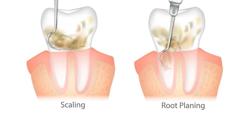 Dental Scaling and Root Planning