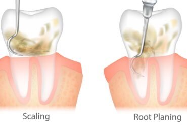 Dental Scaling and Root Planning