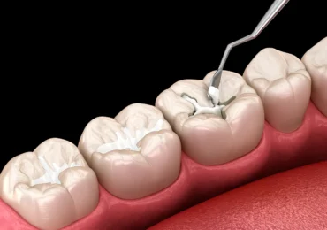 Dental Sealants