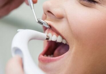 Teeth Polishing